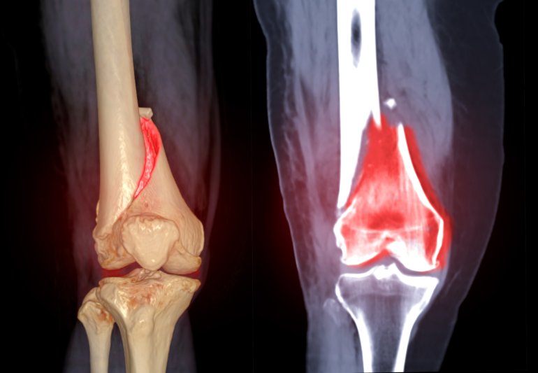 CT knee joint 3D rendering image Front view and Coronal view isolated on black background showing fracture Femur bone.