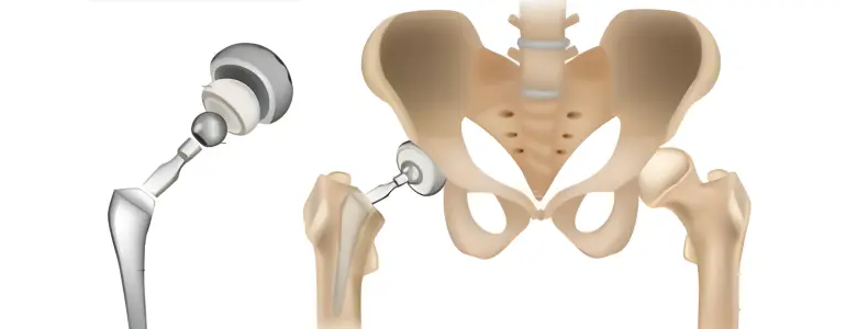 hip replacement surgery in Englewood, NJ