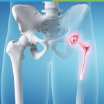 hip replacement in NJ