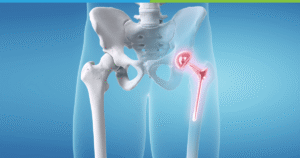 hip replacement in NJ