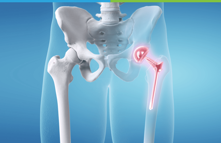 hip replacement in NJ