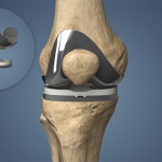 knee replacement surgery near NYC.
