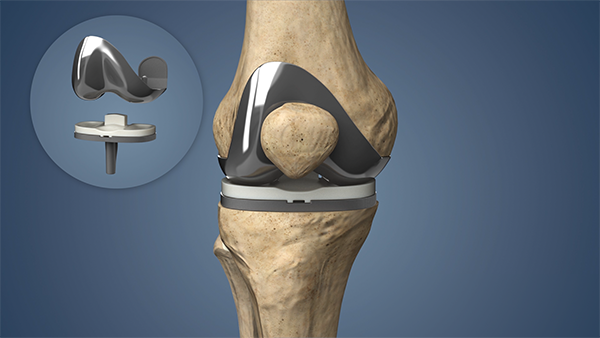 knee replacement surgery near NYC.