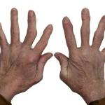 Arthritis Orthopedics Treatment NYC