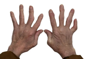 Arthritis Orthopedics Treatment NYC