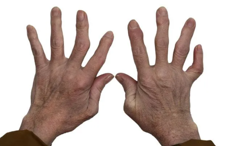 Arthritis Orthopedics Treatment NYC