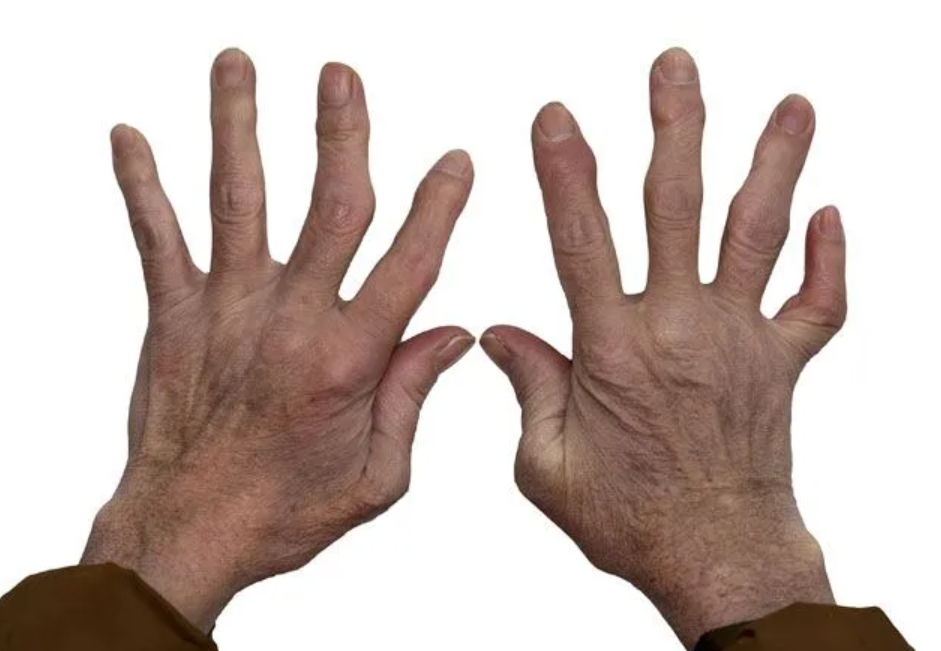 Arthritis Orthopedics Treatment NYC