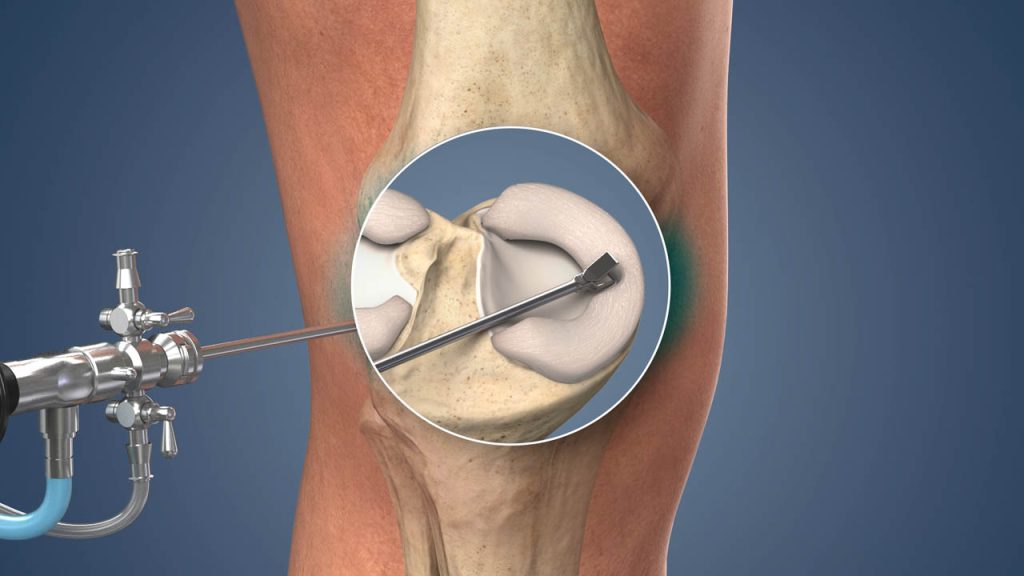 Arthroscopy in New York, NY