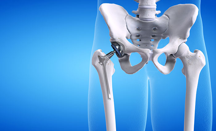 Hip Replacement in New York,