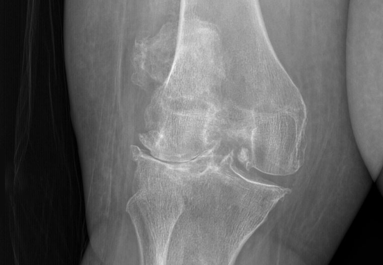 arthritis-treatment-img