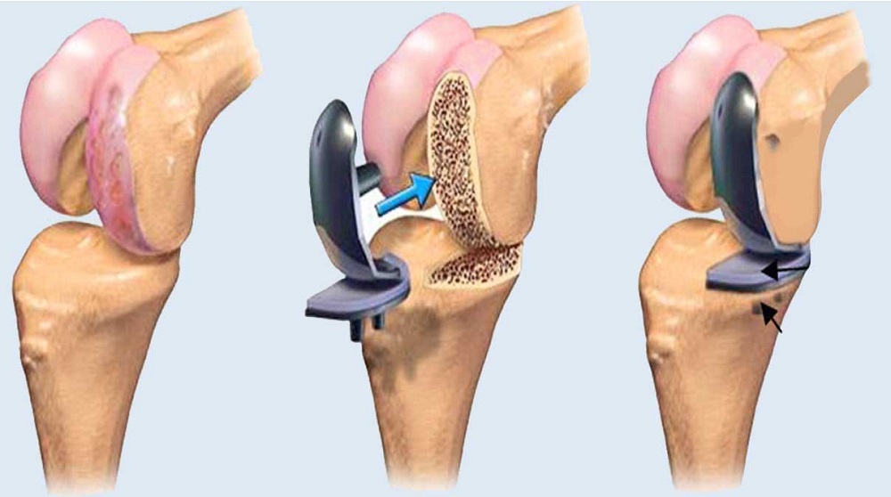 Knee Replacement in Jamaica, Queens