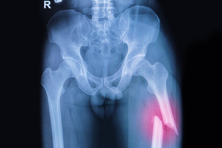 orthopedic hip trauma