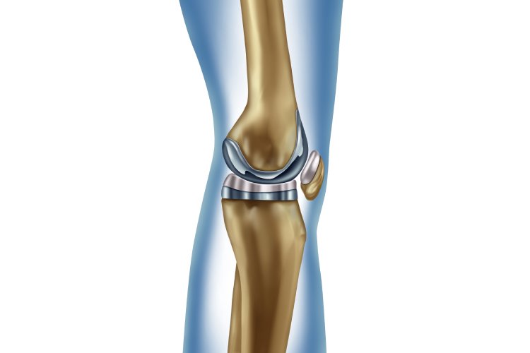 total knee replacement image 333