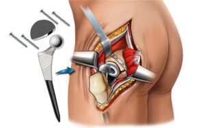 Hip Replacement Englewood NJ