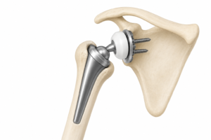 Reverse Shoulder Replacement Surgery