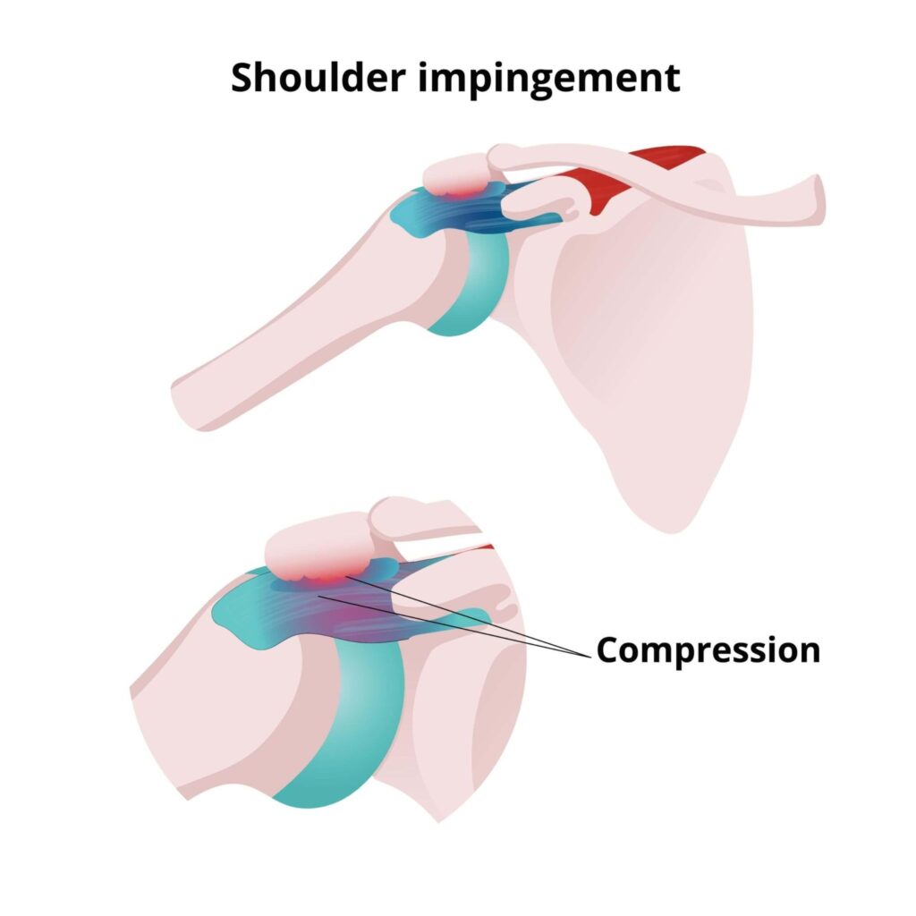 Illustration of shoulder impingement causing pain during arm movement. 
