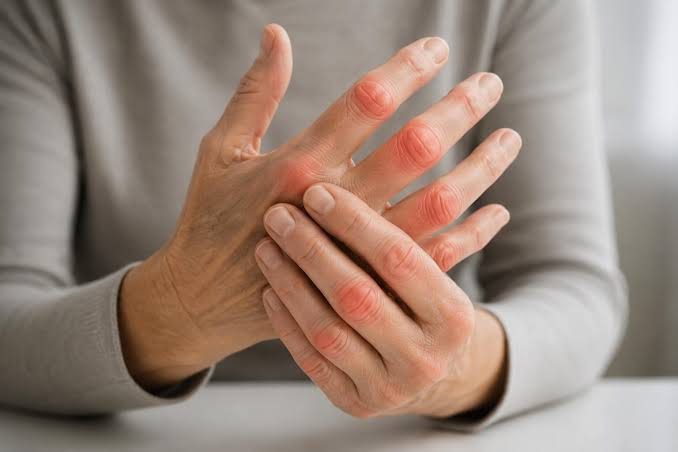 Arthritis in the Hands