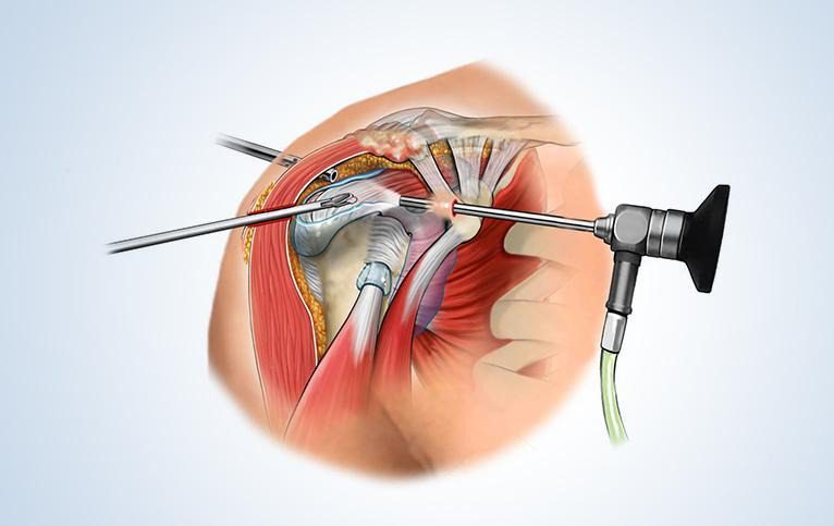 Illustration showing an arthroscope and surgical instruments during arthroscopic shoulder surgery. Rotator Cuff Tear 